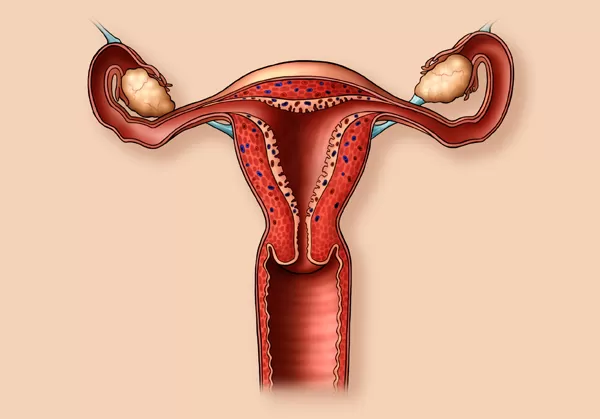 damaged fallopian tubes