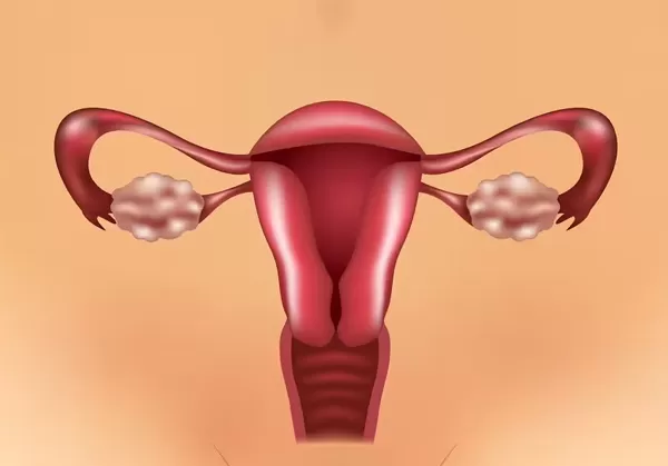 polycystic ovarian