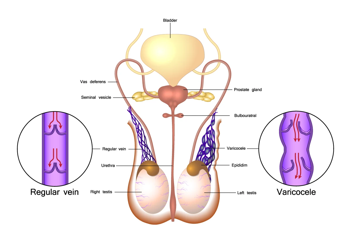 varicocele