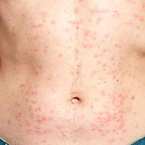 Guttate Psoriasis 10