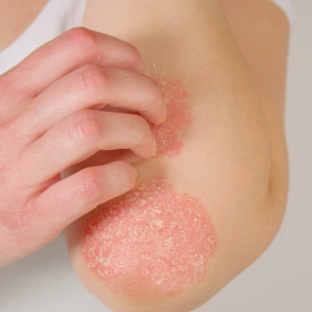 Guttate Psoriasis 11