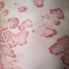 Guttate Psoriasis 12