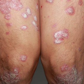 Guttate Psoriasis 13