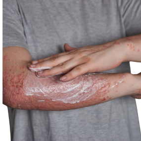 Guttate Psoriasis 14