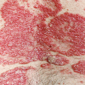 Guttate Psoriasis 20
