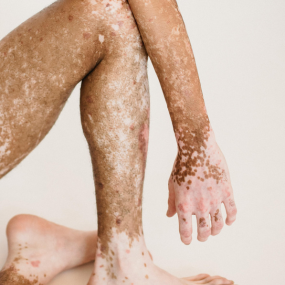 Guttate Psoriasis 3