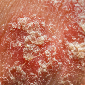 Guttate Psoriasis 4