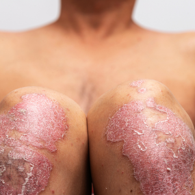 Guttate Psoriasis 5
