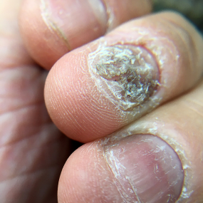 Guttate Psoriasis 6