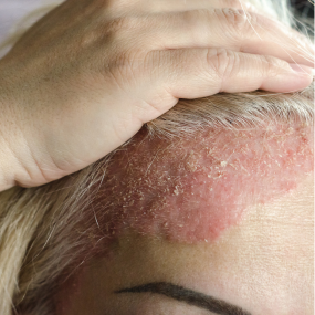 Guttate Psoriasis 7