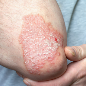 Guttate Psoriasis 8