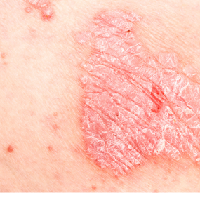 Guttate Psoriasis 9