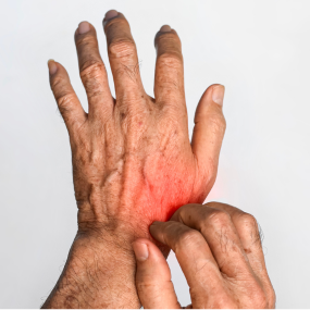Guttate Psoriasis